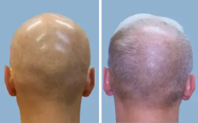 Before and After